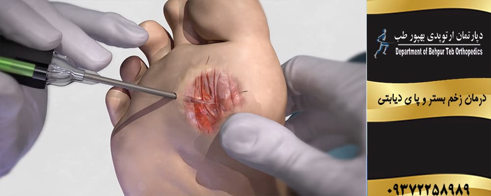 درمان زخم بستر و پا ی دیابتی در منزل