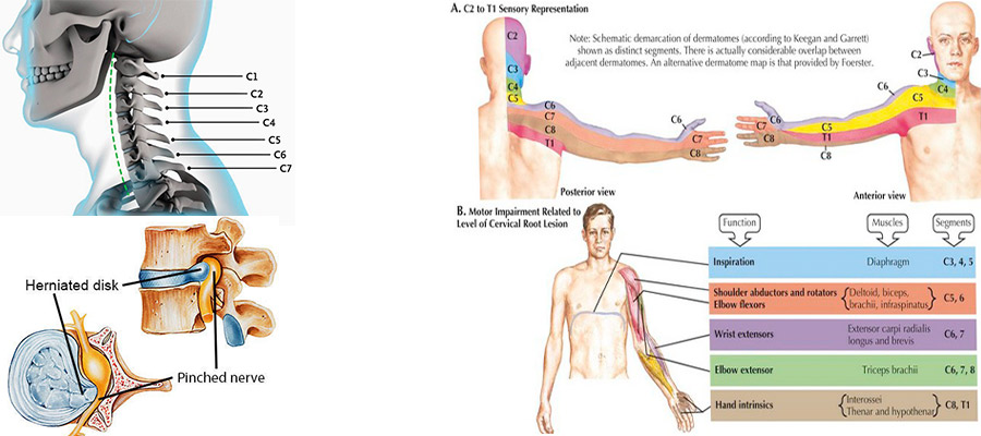 فتق دیسک C5,C6,C7,C8,T1
