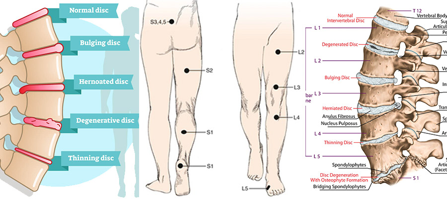 فتق دیسک کمر