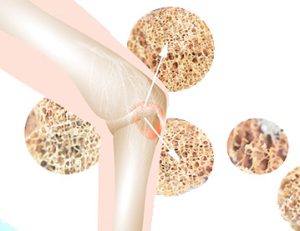 پوکی استخوان زانو بهپور طب