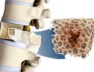 پوکی استخوان ستون فقرات