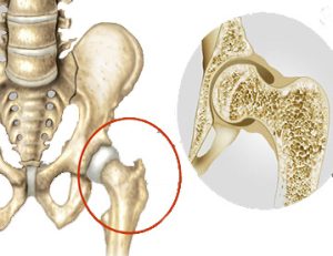 پوکی استخوان لگن بهپور طب